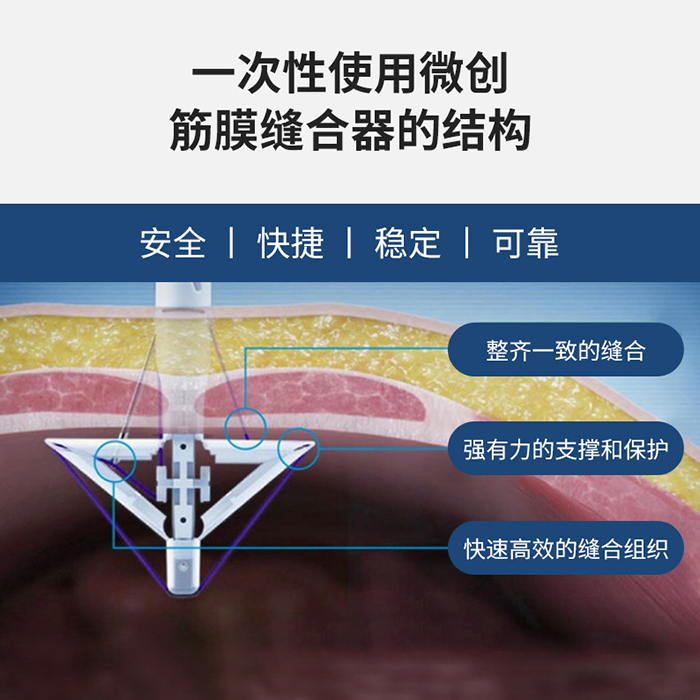 舒擴 一次性使用微創筋膜縫合器